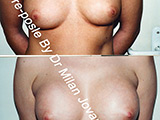 Before and after breast augmentation