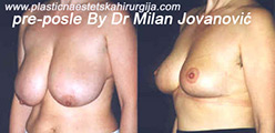Before breast reduction | After four months