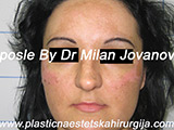 Face chemical peel after seven days