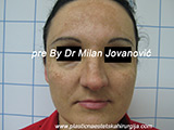 Before face chemical peel
