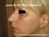 Result after facial fat grafting