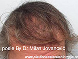 Results after one year after hair transplantation