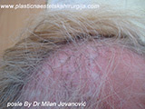 Results after two years after hair transplantation
